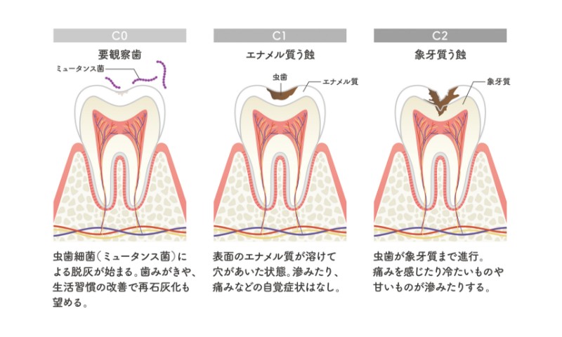 初期の虫歯の治療