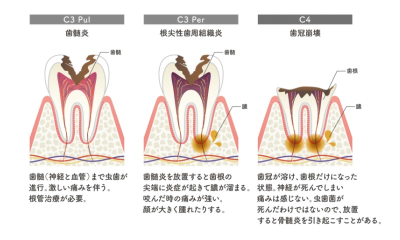 中期後期の虫歯治療