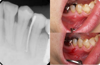 C3 Per《 根尖性歯周組織炎 》