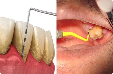 歯周検査
